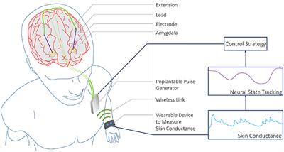 Skin Conductance as a Viable Alternative for Closing the Deep Brain Stimulation Loop in Neuropsychiatric Disorders
